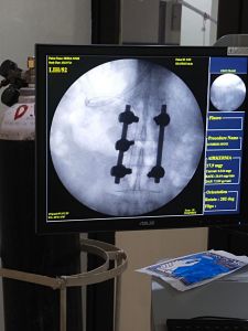 जिला अस्पताल में 80 वर्षीय महिला के लंबर स्पाइन का हुआ सफल इलाज जिला अस्पताल में 80 वर्षीय महिला के लंबर स्पाइन का हुआ सफल इलाज