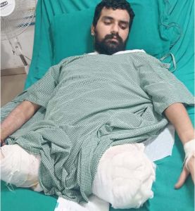  दुर्घटना में कट गये थे दोनों पांव, फिर भी बचा ली जान