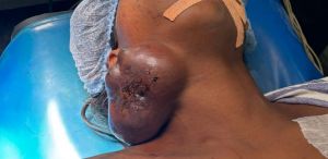 बैगा जनजाति की 25 वर्षीय महिला में मिला दुर्लभ कैंसर बैगा जनजाति की 25 वर्षीय महिला में मिला दुर्लभ कैंसर