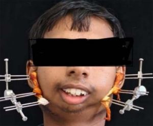 जटिल सर्जरी से खुला मुंह, आयुष्मान योजना से मिला निःशुल्क उपचार
