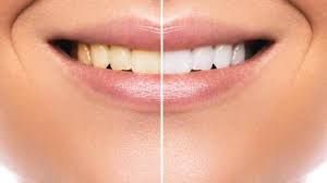 आयुर्वेद: सफेद दांतों के लिए अपनाएं ये आयुर्वेदिक तरीके, कुछ ही दिन में दूर हो जाएगा पीलापन