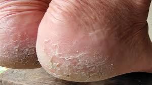   फटी एड़ियों के कारण चलने में हो रही है दिक्कत, एलोवेरा और देसी घी से मिलेगा आराम