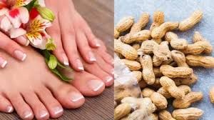 फटी एड़ियों को ठीक करने में मदद करेगा मूंगफली का छिलका