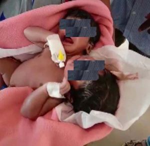  ओडिशा में 2 सिर और 3 हाथ के साथ जन्मी जुड़वा बच्चियां