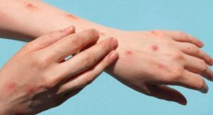  केरल में मंकीपॉक्स का तीसरा मामला सामने आया