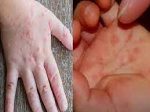  केंद्र ने हाथ, पैर और मुंह की बीमारी- टोमैटो फ्लू से बचने के लिए राज्यों को परामर्श जारी किया