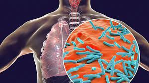  कोविड के कारण 2020 में 15 लाख अधिक लोग टीबी के इलाज से चूक गए : अध्ययन
