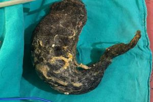 युवती के पेट से निकले दो किलोग्राम बाल : &lsquo;ट्राइकोफेजिया' बीमारी से पड़ती है बाल खाने की आदत