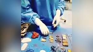 लड़के के पेट से बैटरी, ब्लेड समेत धातु की 56 वस्तुएं निकाली गईं; सर्जरी के बाद मरीज की मौत