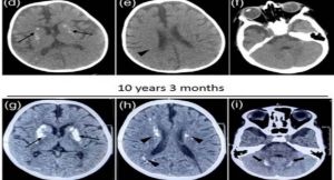 भारतीय वैज्ञानिकों ने बच्चों में दुर्लभ USP18 जीन म्यूटेशन की पहचान की